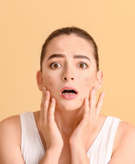 acne treatment Alysia Clinic